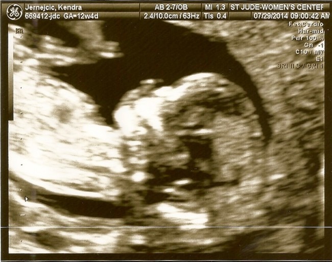 Baby at 12 weeks. This baby doesn't know how lucky he/she is not to have a sense of smell!