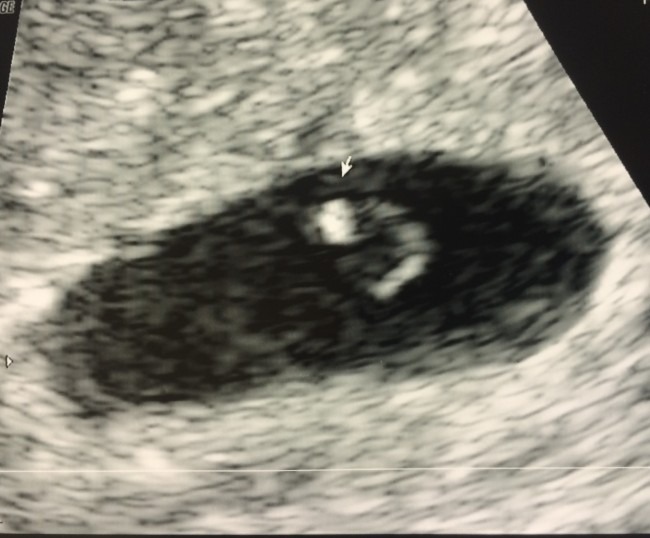 First Sonograph